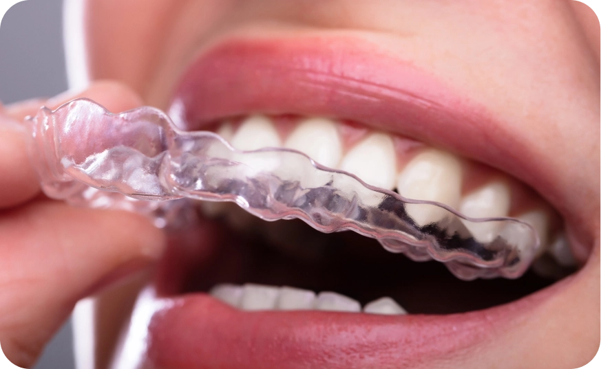 Bruxismo | Tratamientos I.M Dental