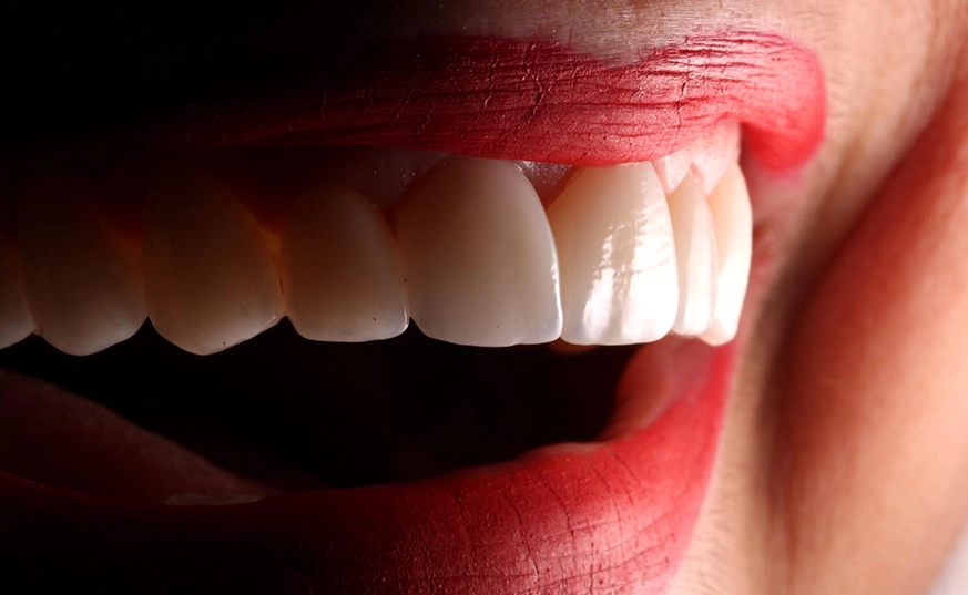 Carillas dentales | I.M Dental