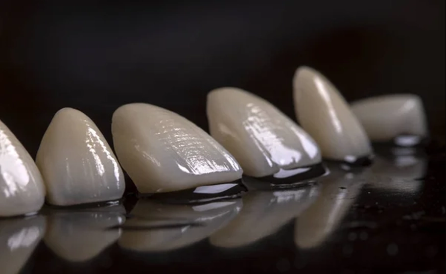 Carillas dentales | I.M Dental