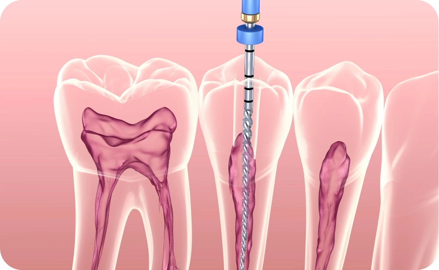 Endodoncia | Tratamientos I.M Dental