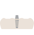 Implantes | I.M Dental